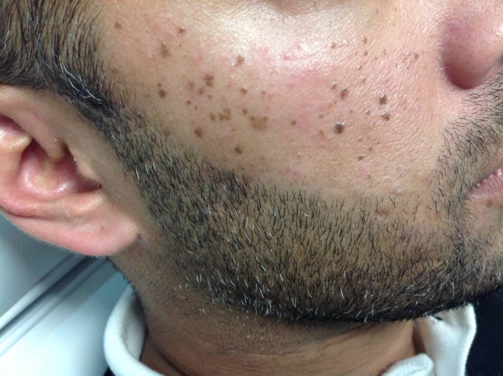 Mole Removal Treatment Portsmouth Mole Removal Treatment