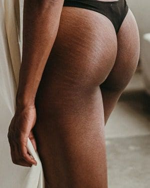 Stretch marks and how to get rid of them