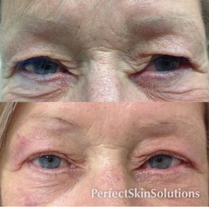 plexr eye lift