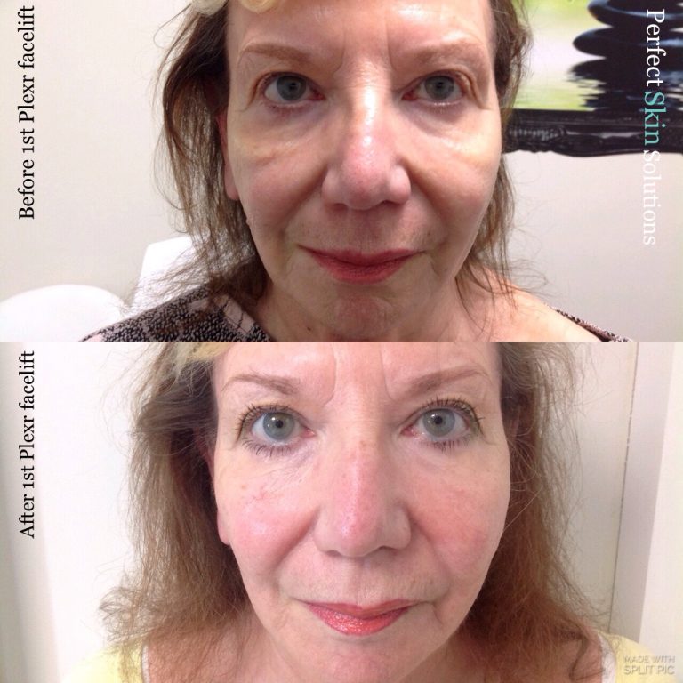 NonSurgical Face Lift Perfect Skin Solutions