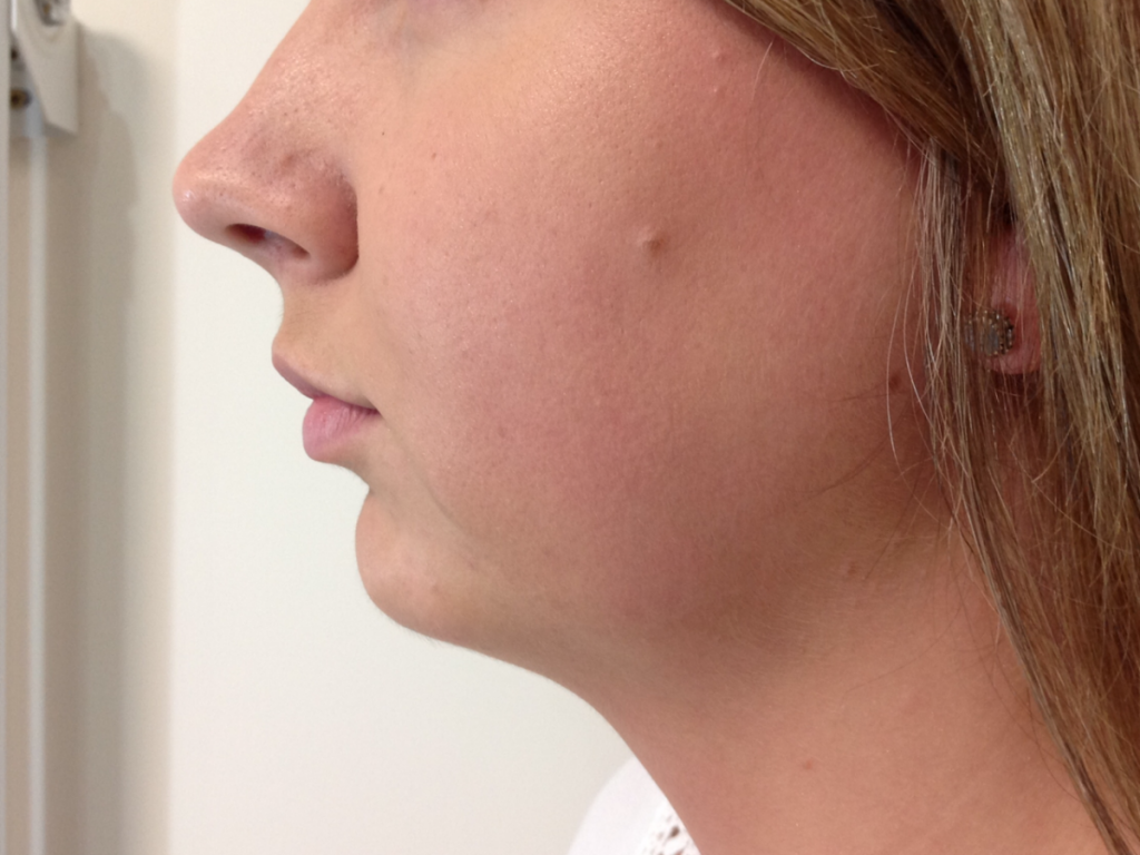 Chin Correction Perfect Skin Solutions