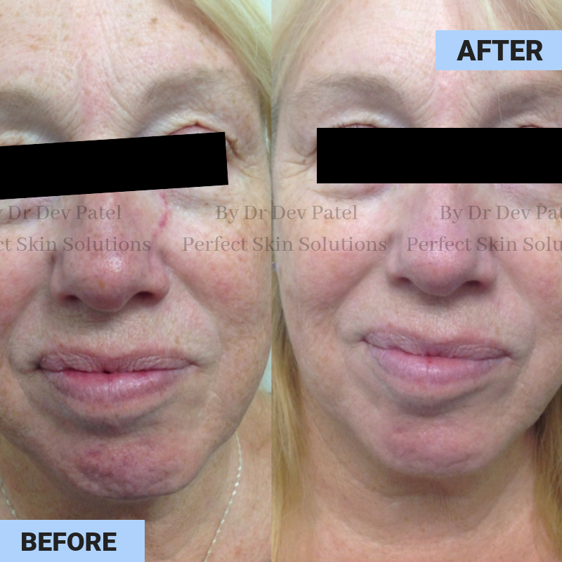 Harmony Xl Pro Laser System Perfect Skin Solutions.