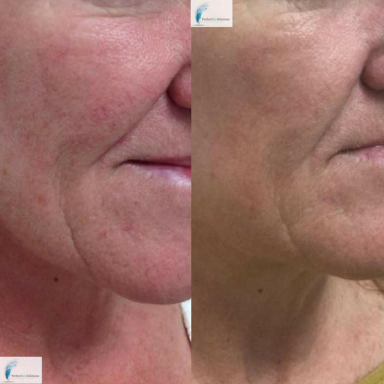 Harmony XL Pro Laser System Perfect Skin Solutions