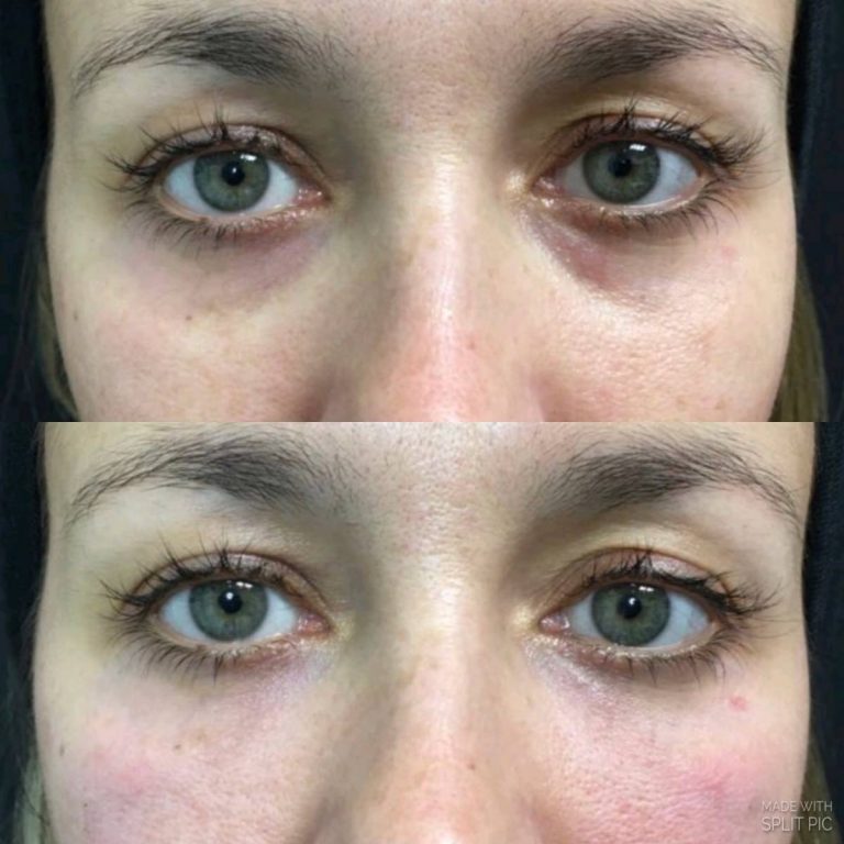 Tear Trough Before and after - Perfect Skin Solutions