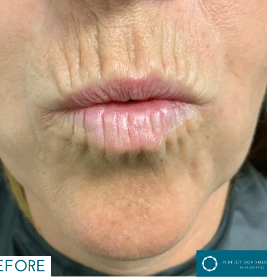 Does Plexr Really Work? Your Complete Guide to Plasma Soft Surgery for Excess Skin and More