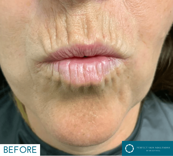 plexr treatment before