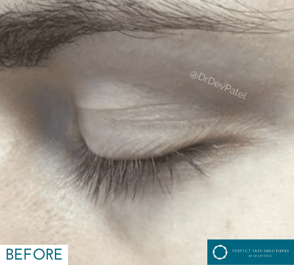 plexr treatment before