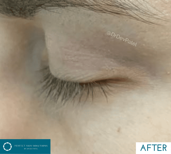 plexr treatment after