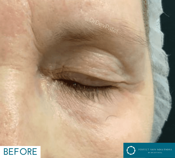 plexr treatment before