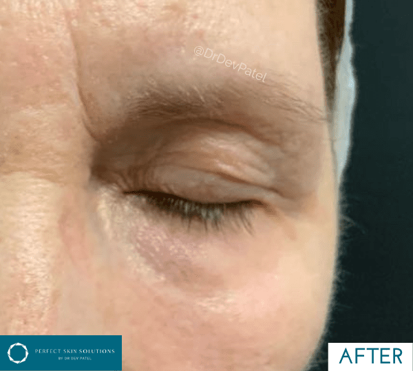 plexr treatment after