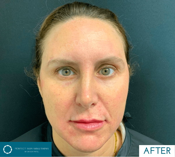 dermal fillers treatment after
