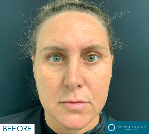 dermal fillers treatment before