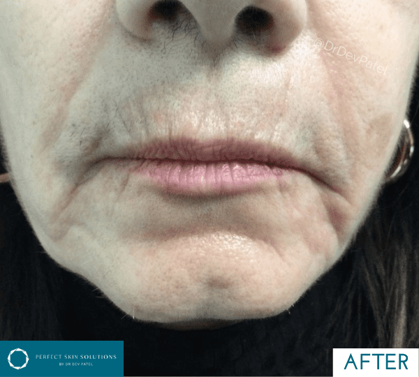 plexr treatment after