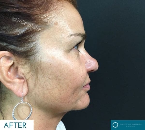 Morpheus8 treatment after