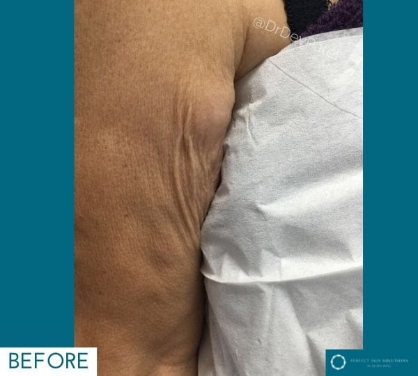 Morpheus8 skin tightening treatment on arm before