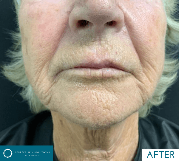 plexr treatment after