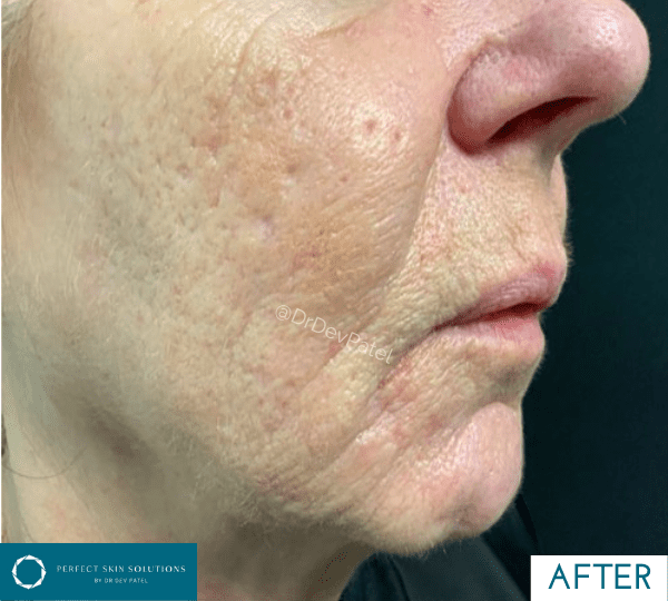 plexr treatment after