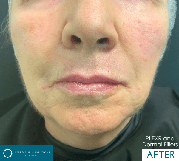 plexr plus treatment after