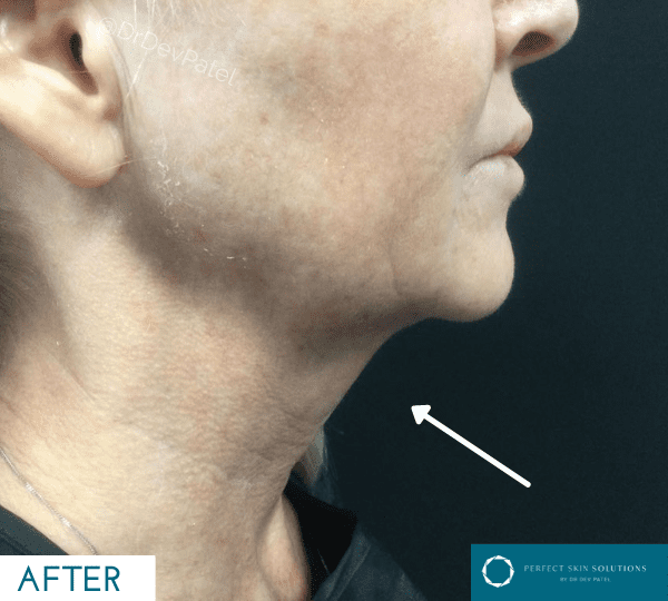 Morpheus8 skin tightening treatment after