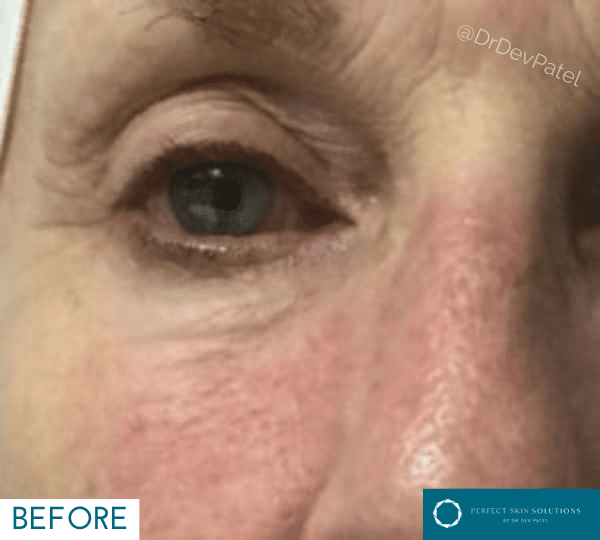 celluma led light therapy treatment before