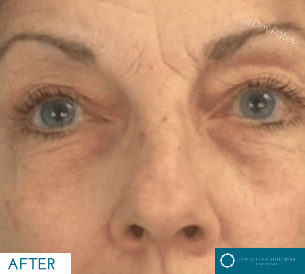 celluma led light therapy treatment after