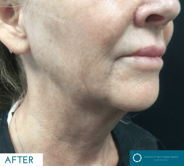 Morpheus 8 skin tightening treatment after