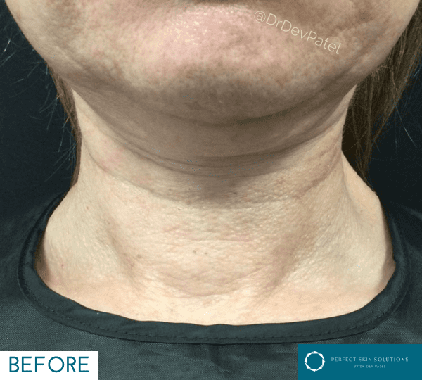 Morpheus8 skin tightening treatment before