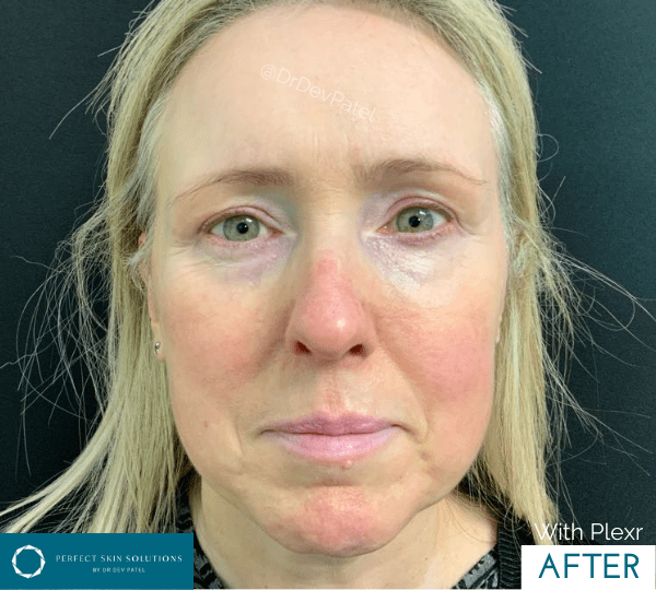 dermal filler treatment after