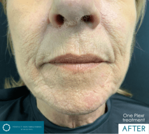 plexr treatment after