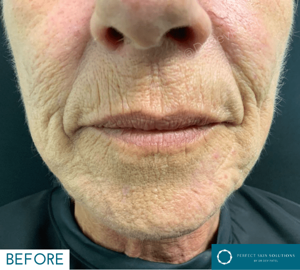 plexr treatment before