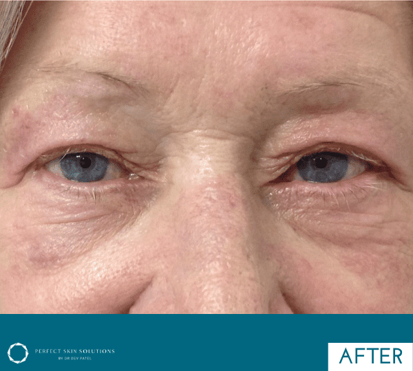 plexr plus treatment after