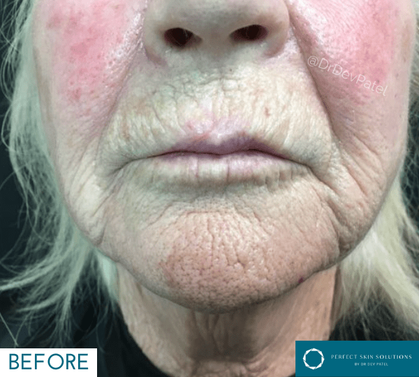 plexr treatment before