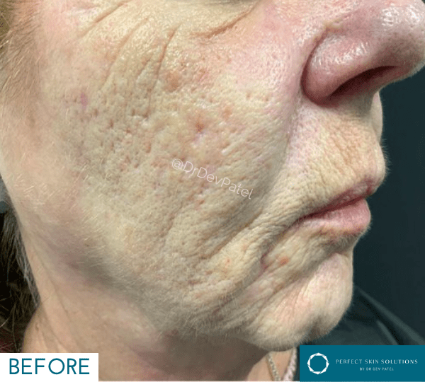 plexr treatment before