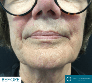 plexr treatment before