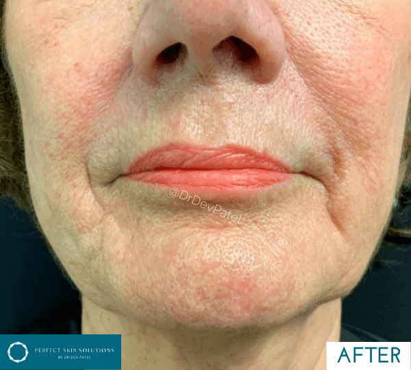 plexr treatment after