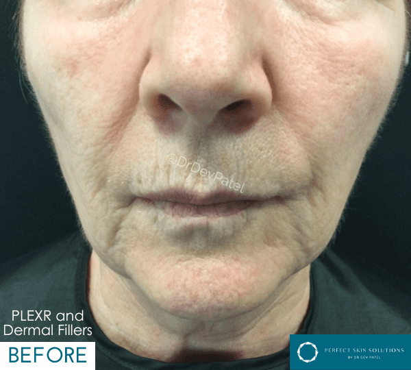 plexr plus treatment before