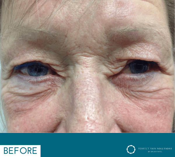 plexr plus treatment before