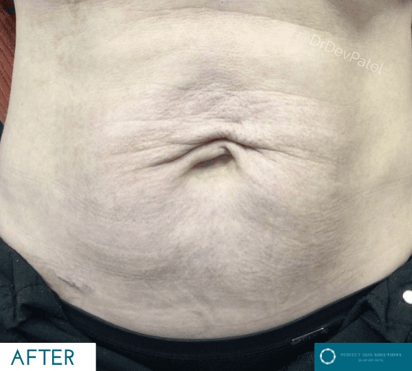 Morpheus8 skin tightening treatment after