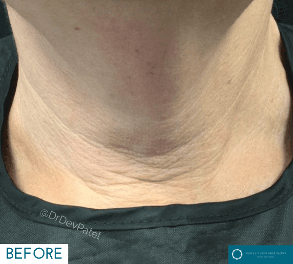 Morpheus8 skin tightening treatment before