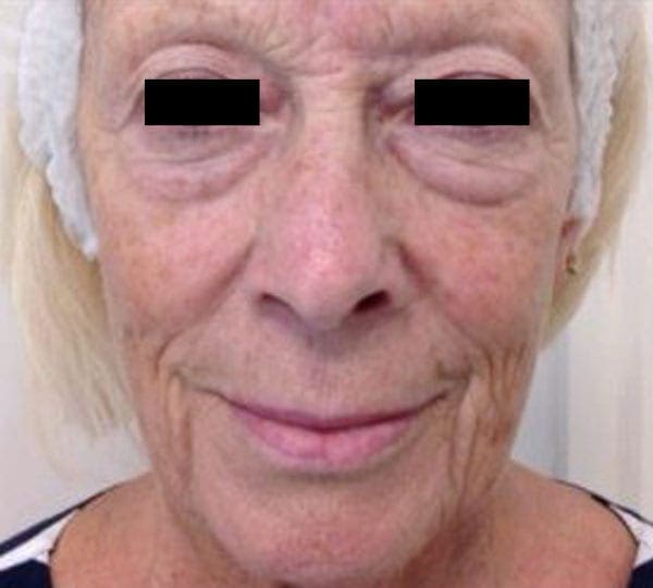 dermal fillers treatment before