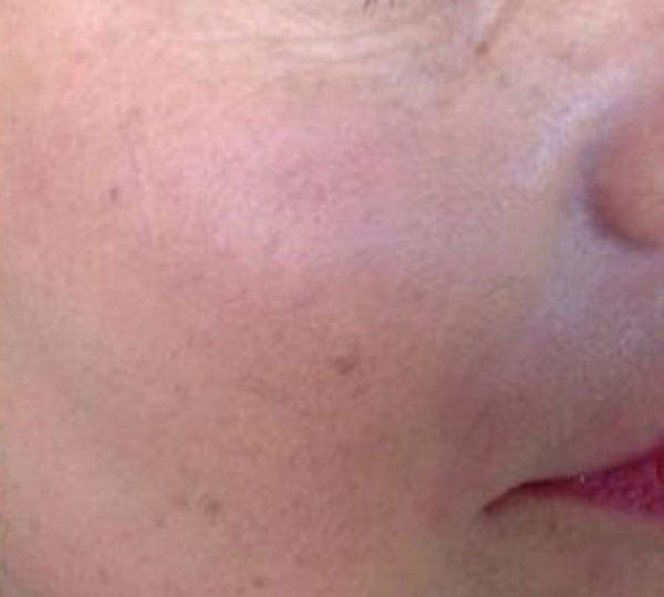 cheek filler treatment after