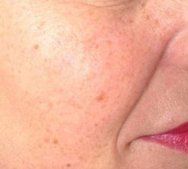 cheek filler treatment before