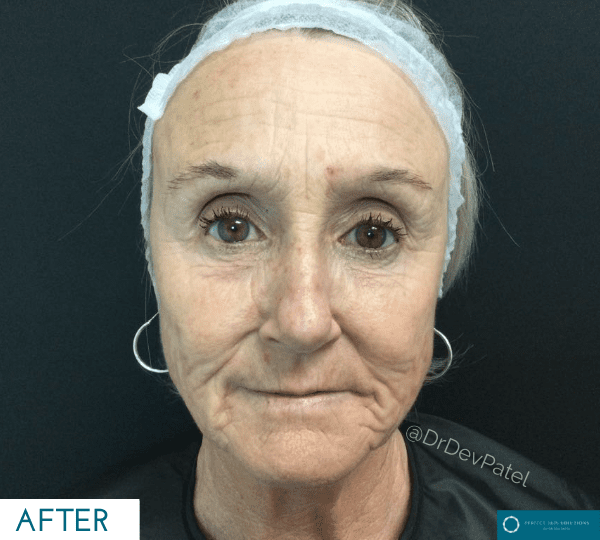 Morpheus8 skin tightening treatment before
