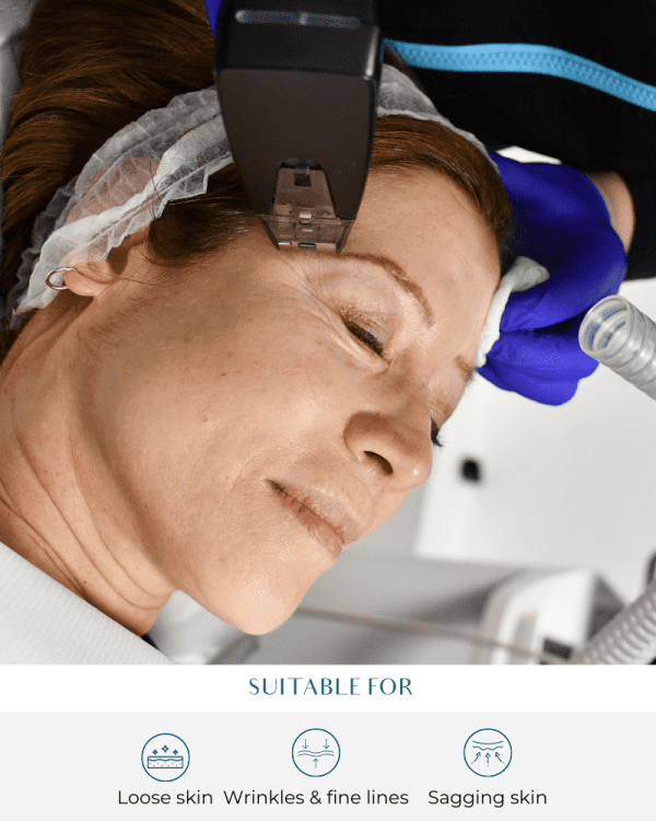 RF Treatment for Cellulite