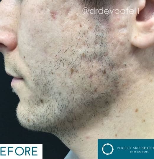 Scars Solutions: Advanced Treatments for Skin Healing and Restoration