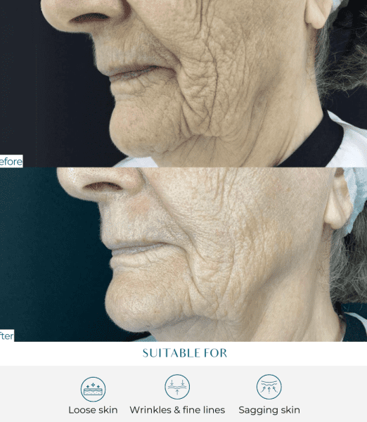 Non-Surgical Facelift