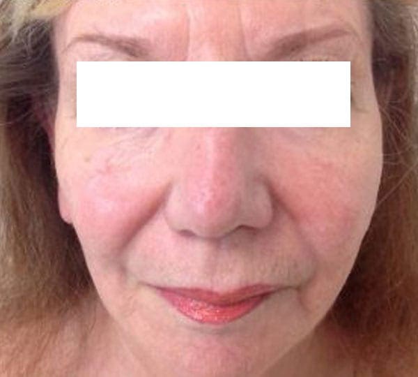 plexr treatment after