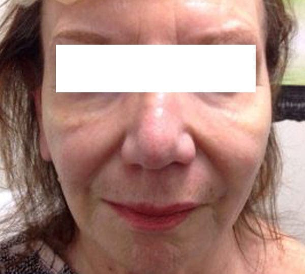 plexr treatment before