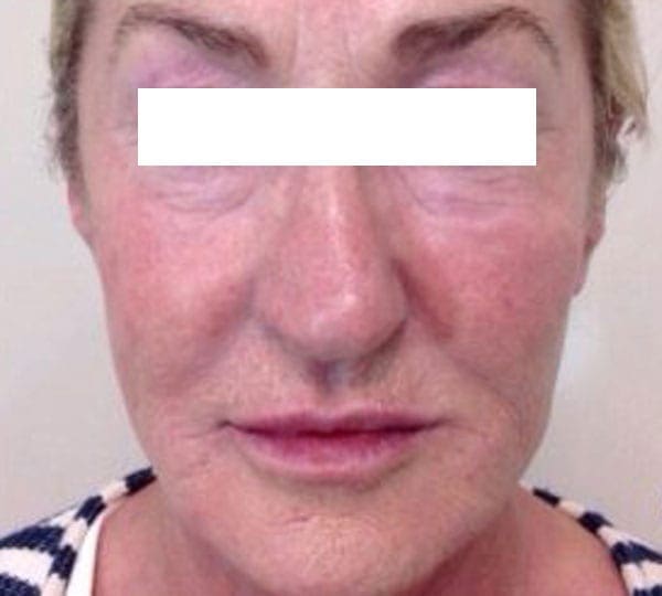 dermal fillers treatment after