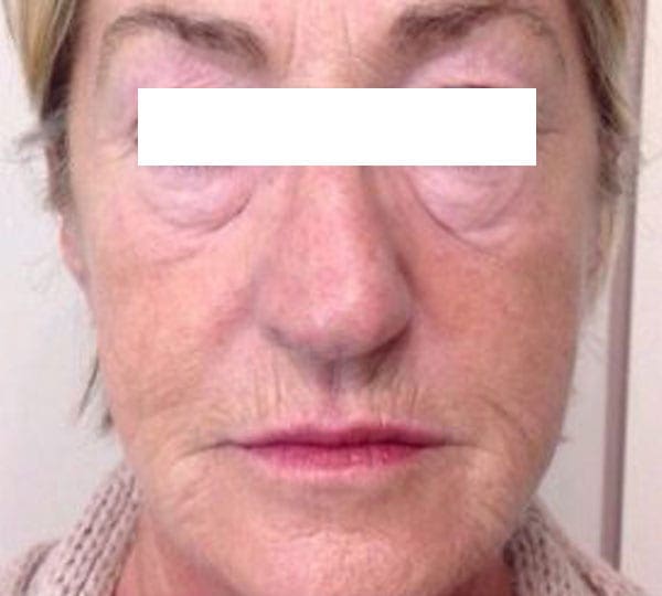 dermal fillers before treatment